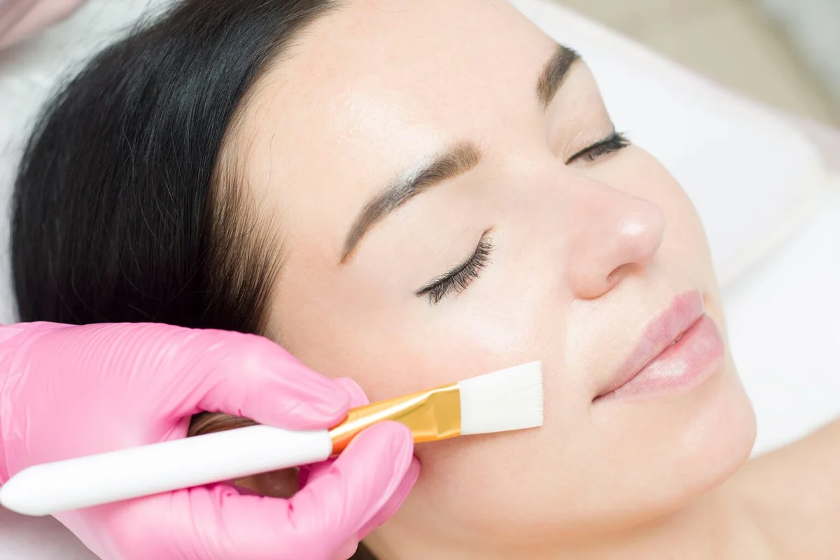 Chemical Peel