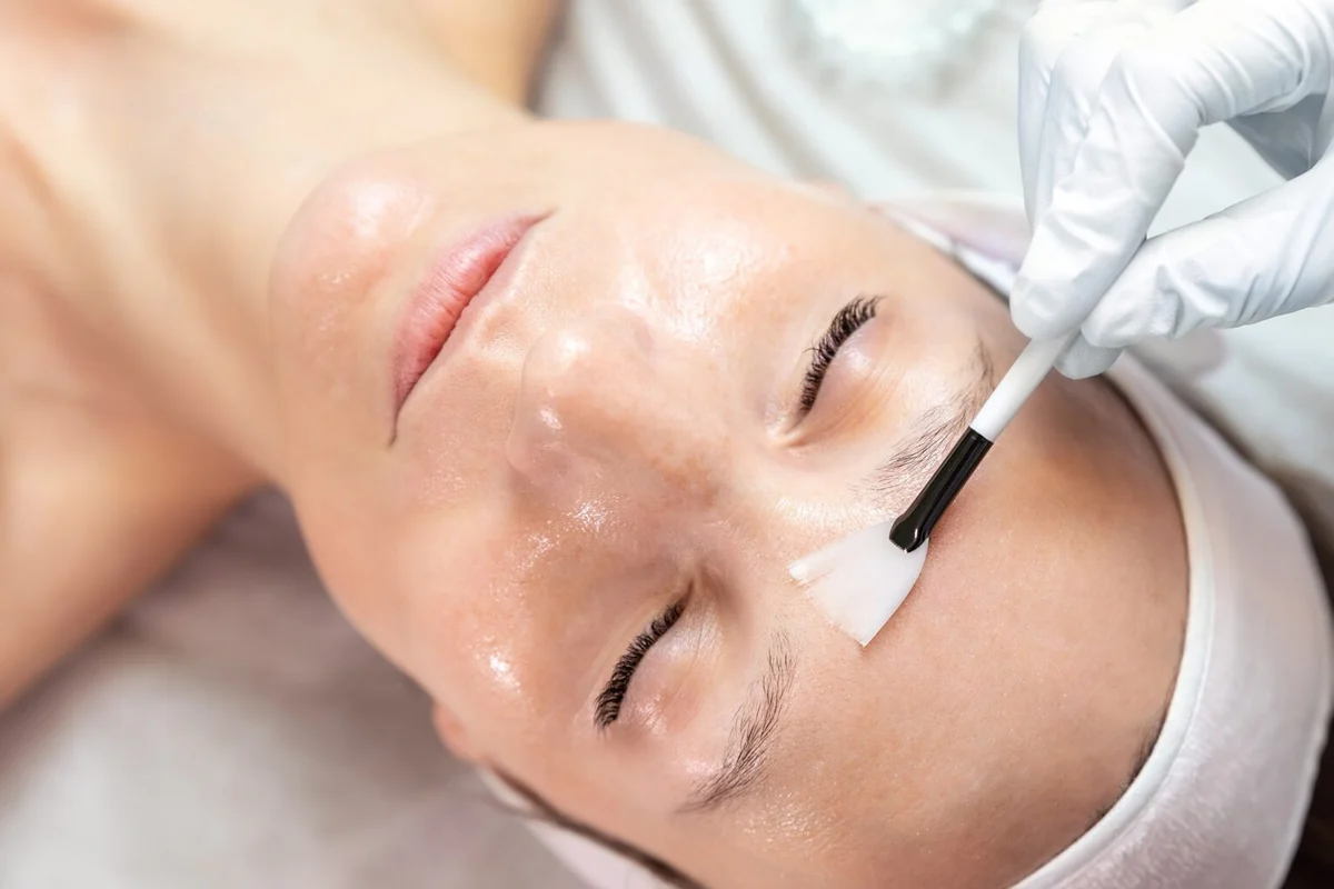 Chemical Peel