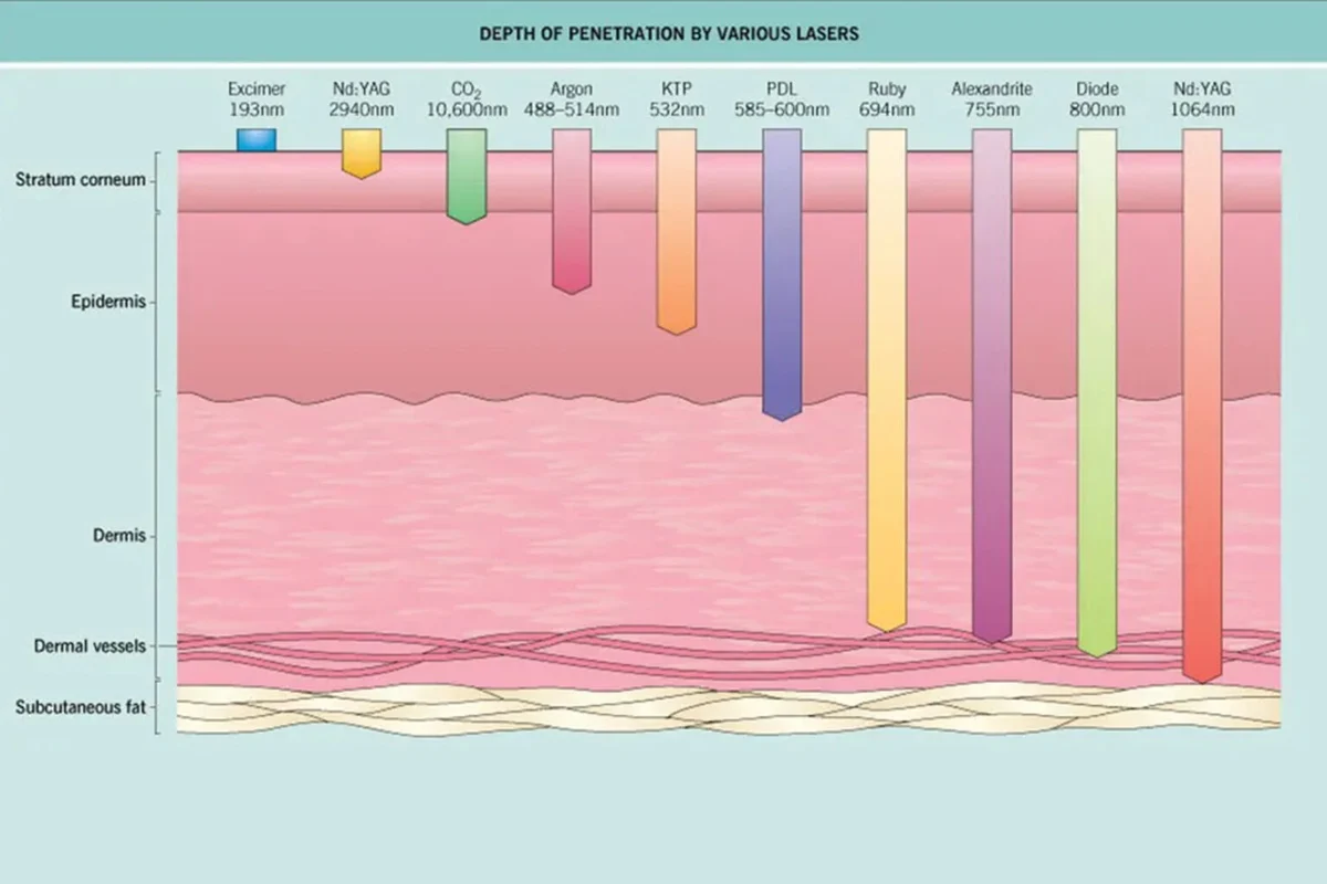 Depth of laser treatment penetration