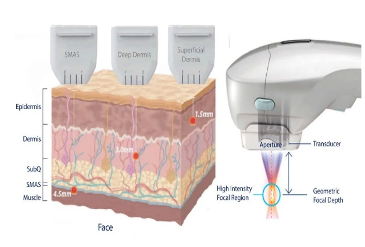 Dr Plus HIFU treatment